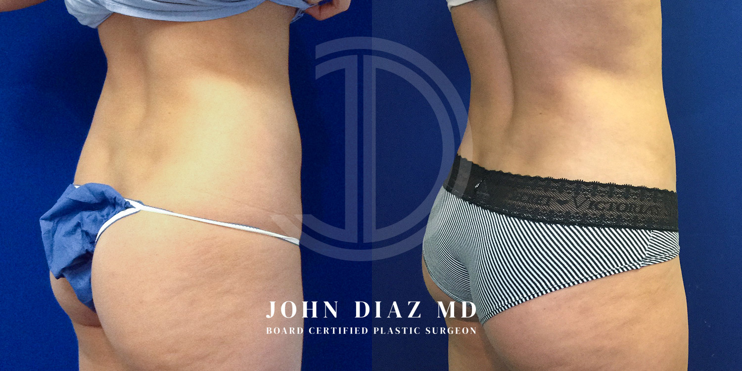 Dr John Diaz Before and After | Liposuction
