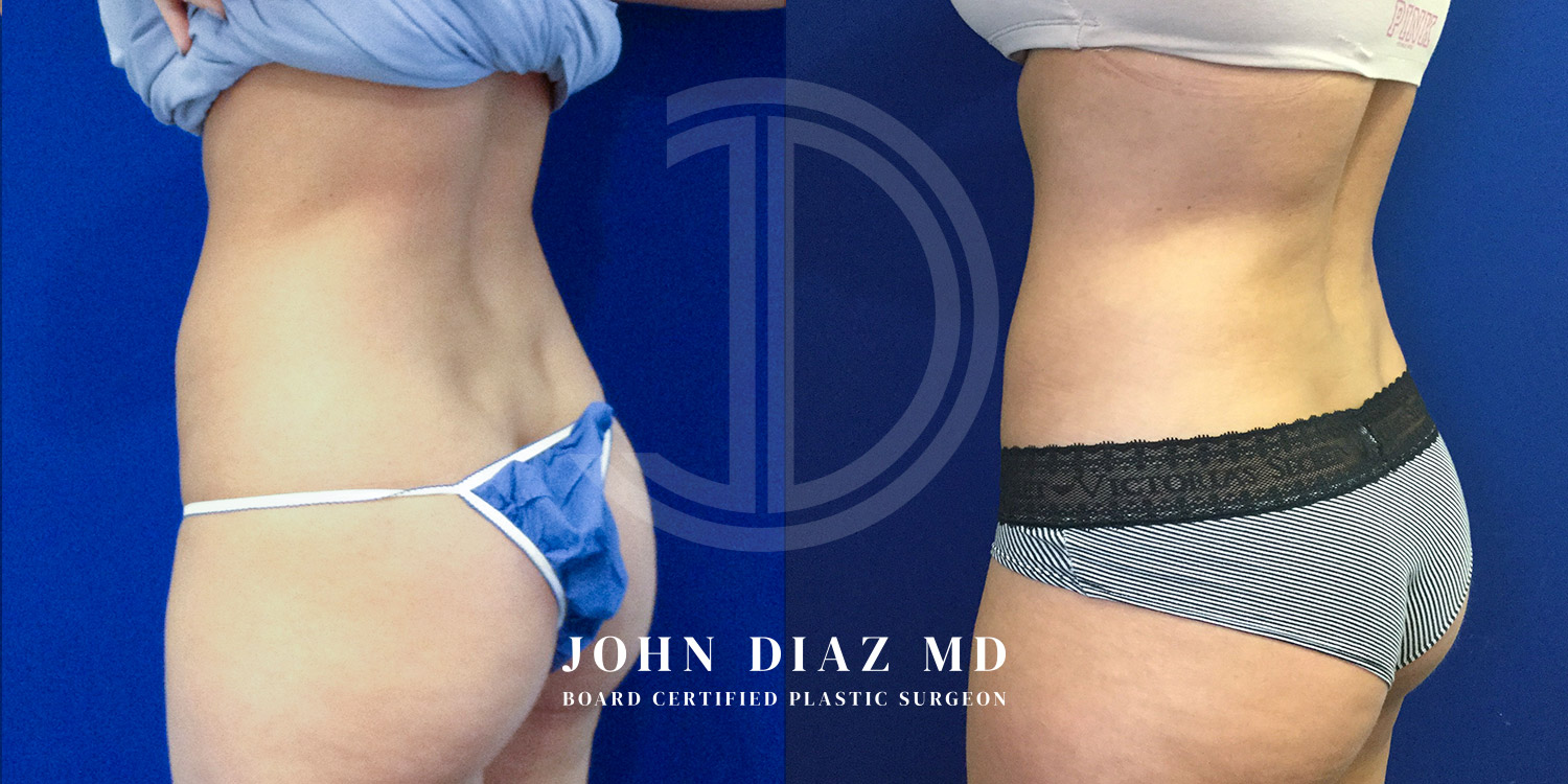Dr John Diaz Before and After | Liposuction