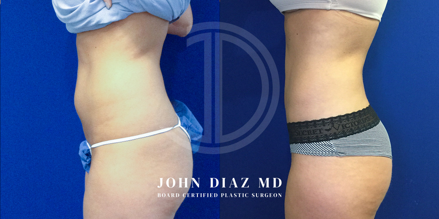 Dr John Diaz Before and After | Liposuction