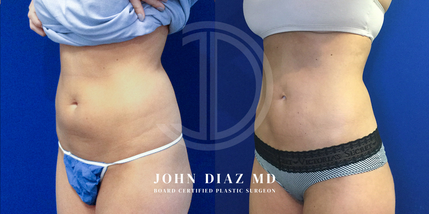 Dr John Diaz Before and After | Liposuction