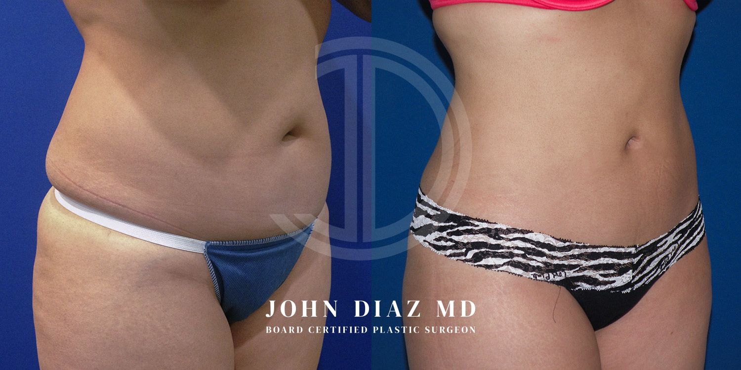 Dr John Diaz Before and After | Liposuction