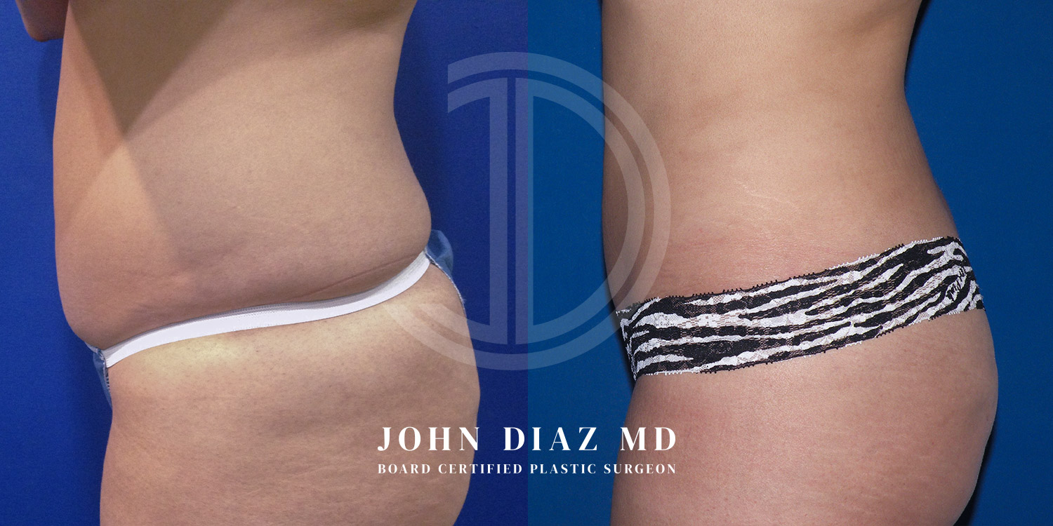 Dr John Diaz Before and After | Liposuction