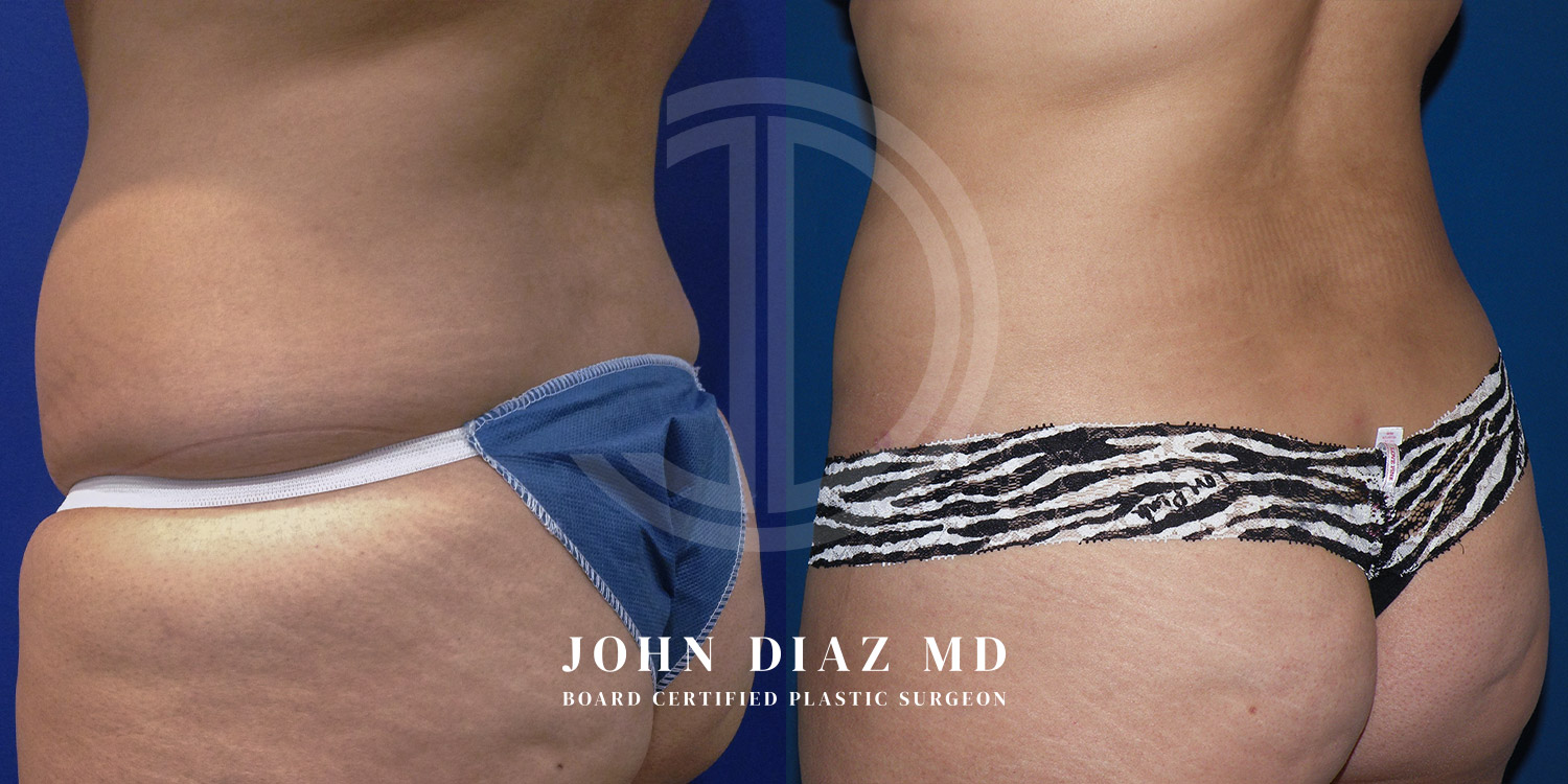Dr John Diaz Before and After | Liposuction