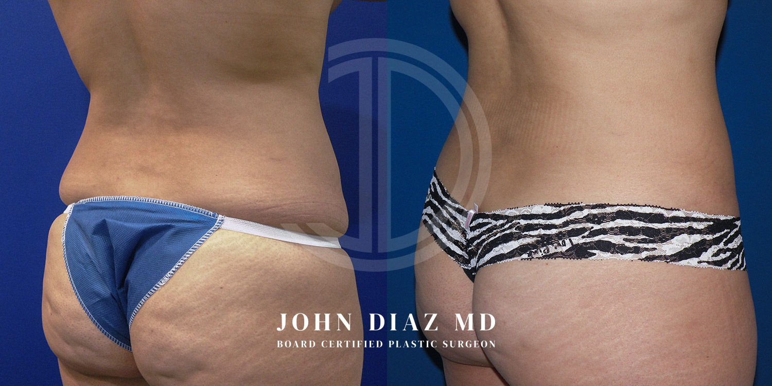 Dr John Diaz Before and After | Liposuction