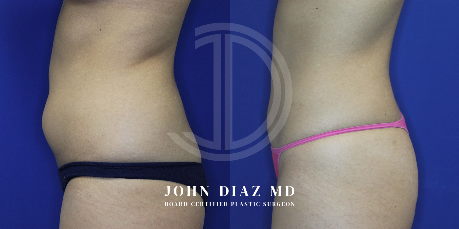 Dr John Diaz Before and After | Liposuction