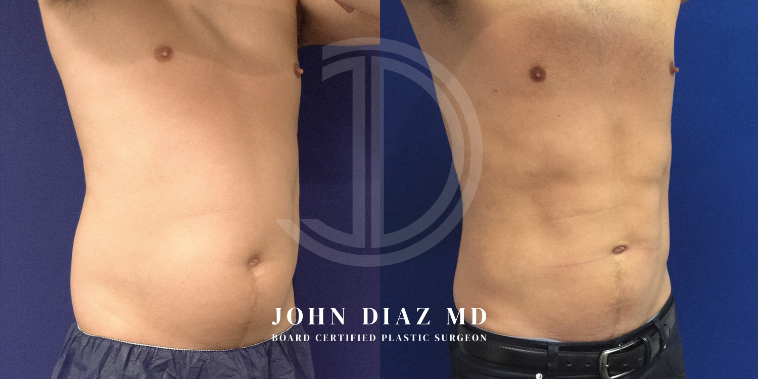 Dr John Diaz Before and After | Liposuction