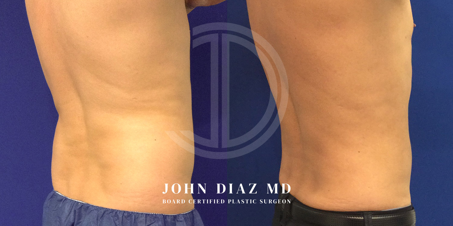 Dr John Diaz Before and After | Liposuction