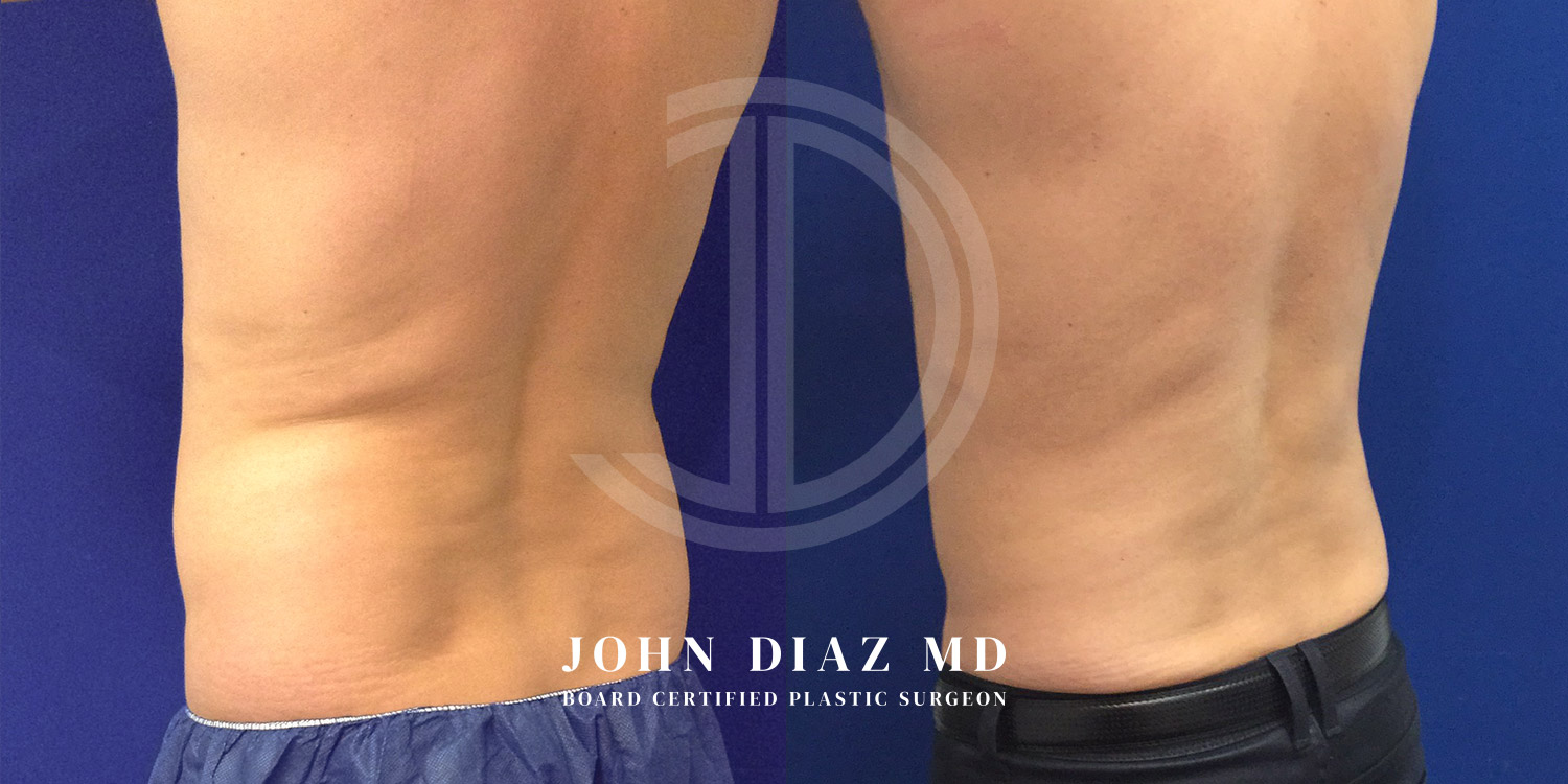 Dr John Diaz Before and After | Liposuction