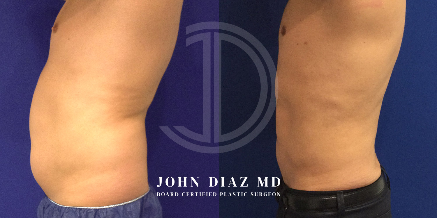 Dr John Diaz Before and After | Liposuction