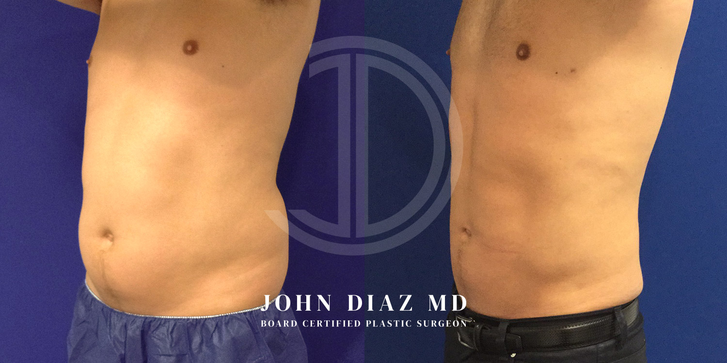 Dr John Diaz Before and After | Liposuction