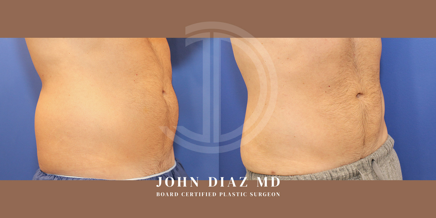 Dr John Diaz Before and After | Liposuction