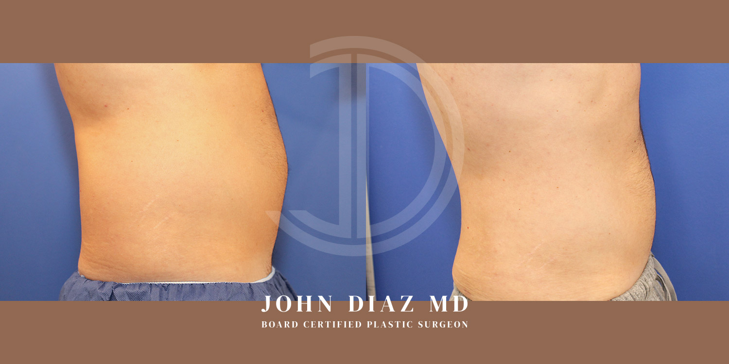 Dr John Diaz Before and After | Liposuction