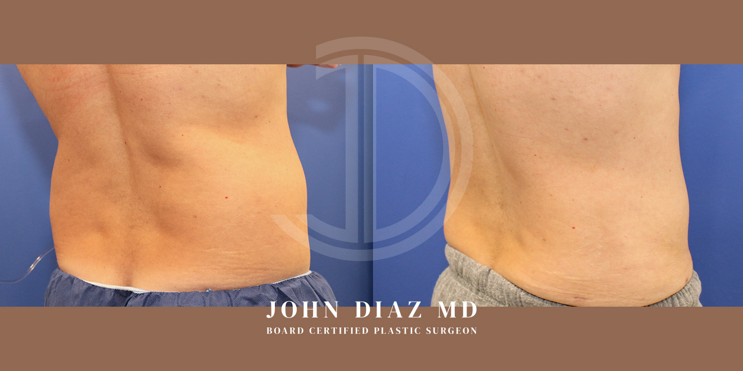 Dr John Diaz Before and After | Liposuction