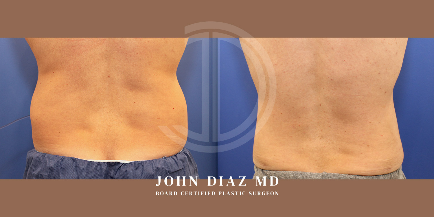 Dr John Diaz Before and After | Liposuction