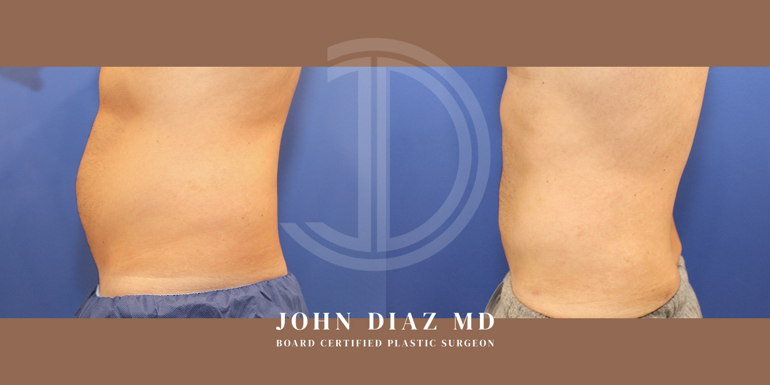 Dr John Diaz Before and After | Liposuction