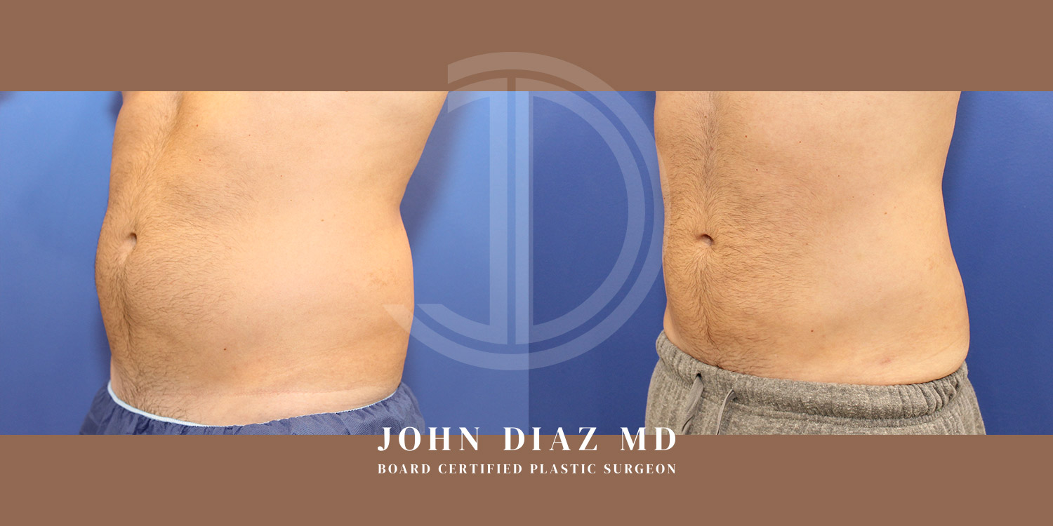 Dr John Diaz Before and After | Liposuction