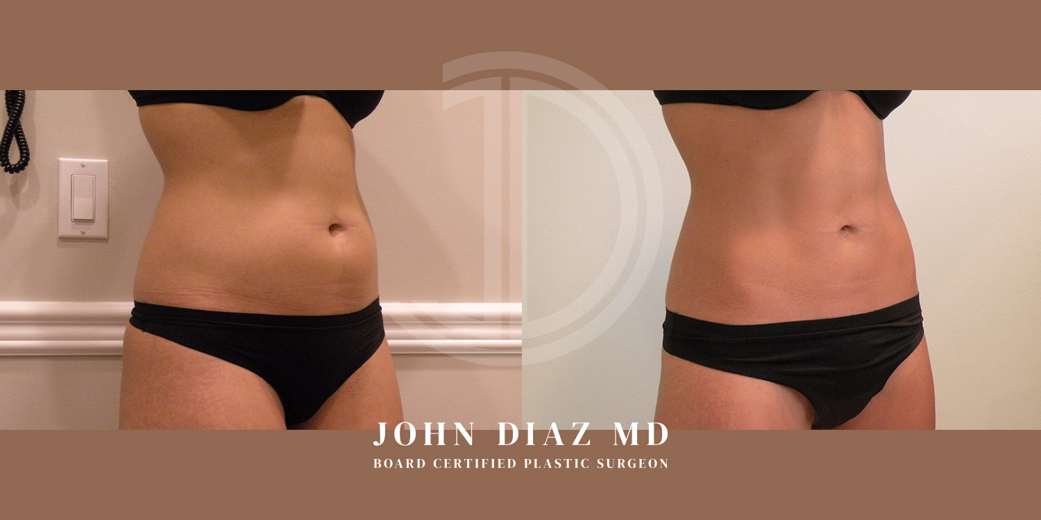 Dr John Diaz Before and After | Liposuction