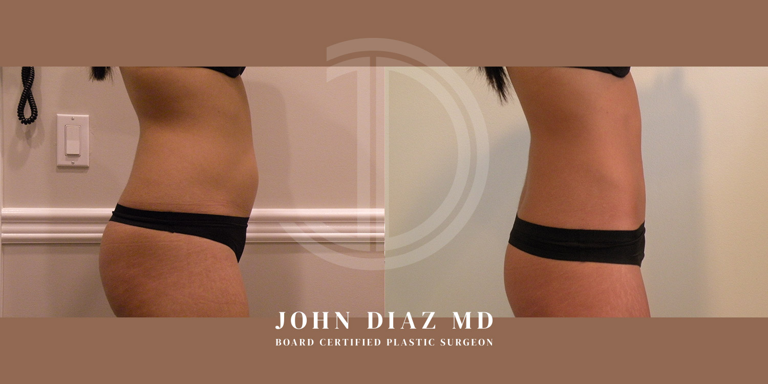 Dr John Diaz Before and After | Liposuction