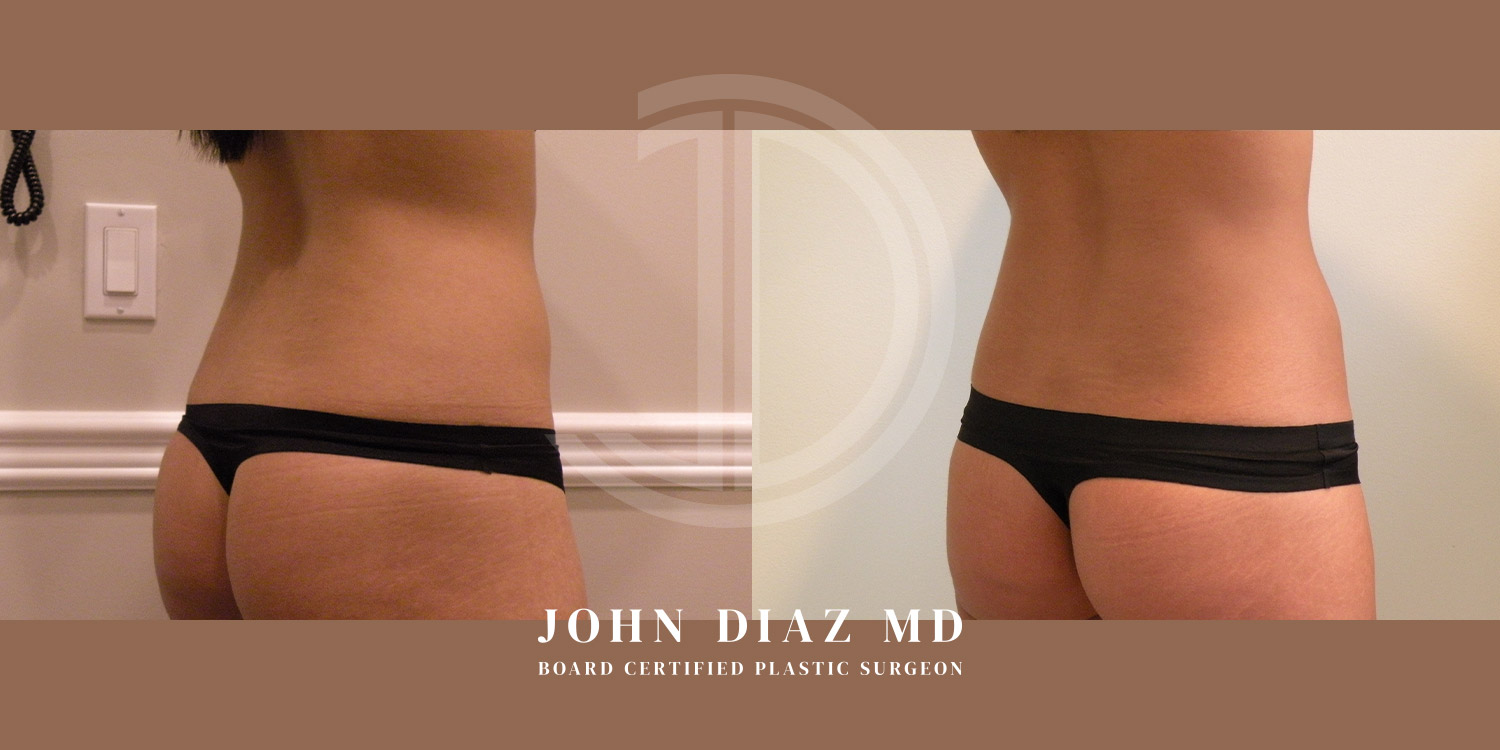 Dr John Diaz Before and After | Liposuction