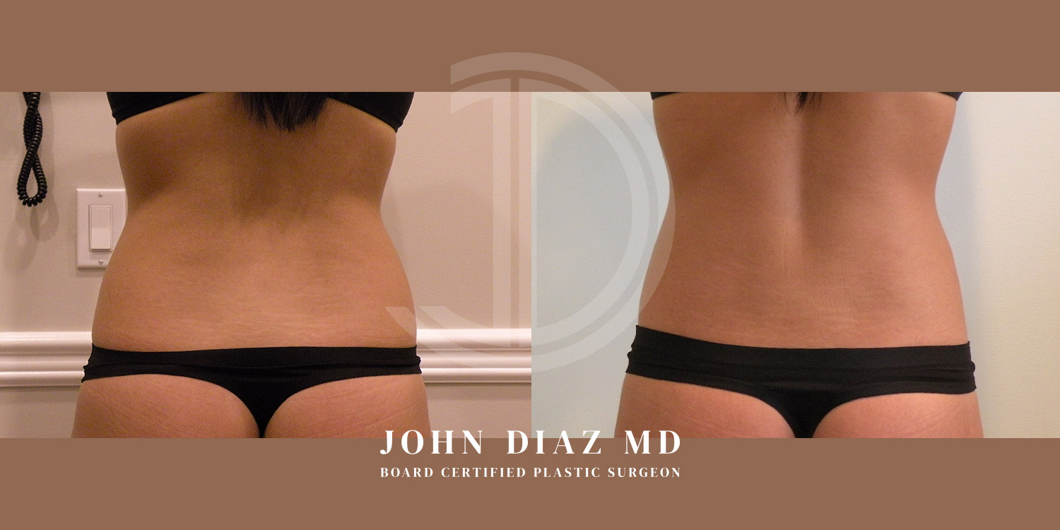 Dr John Diaz Before and After | Liposuction