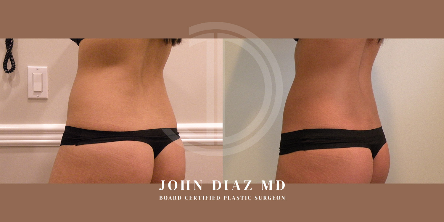 Dr John Diaz Before and After | Liposuction