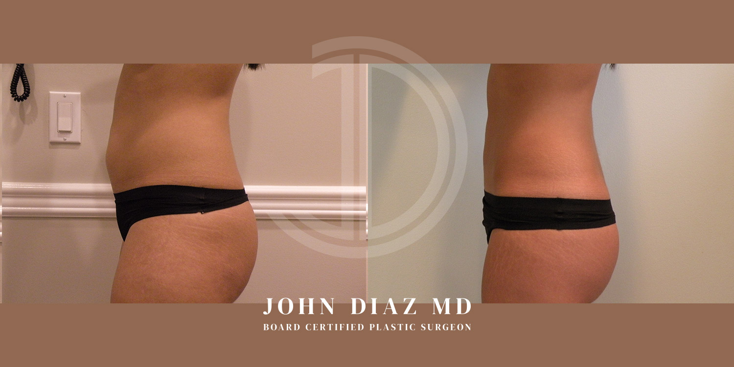 Dr John Diaz Before and After | Liposuction