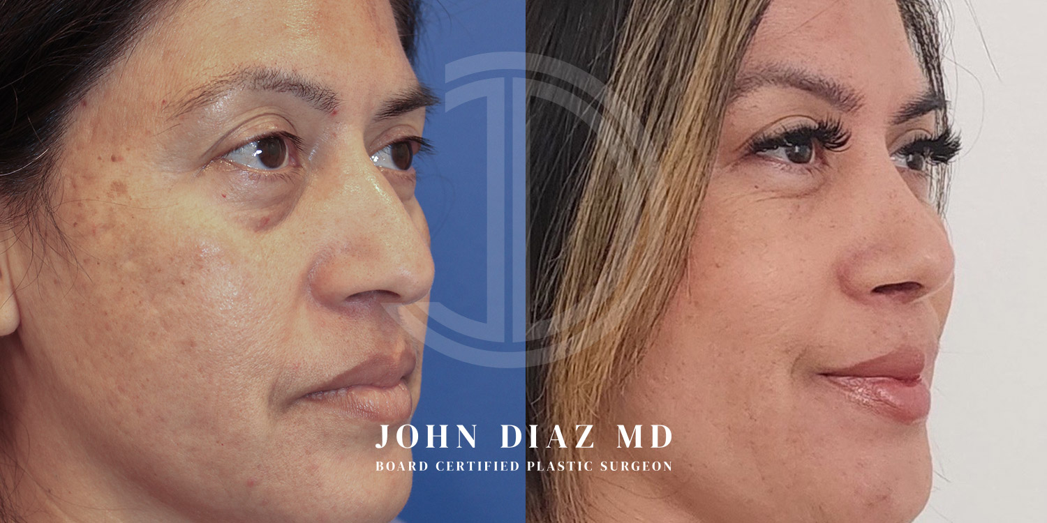 Dr John Diaz Before and After | Rhinoplasty