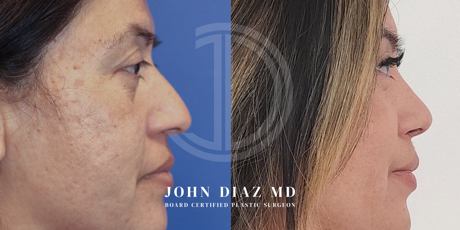 Dr John Diaz Before and After | Rhinoplasty