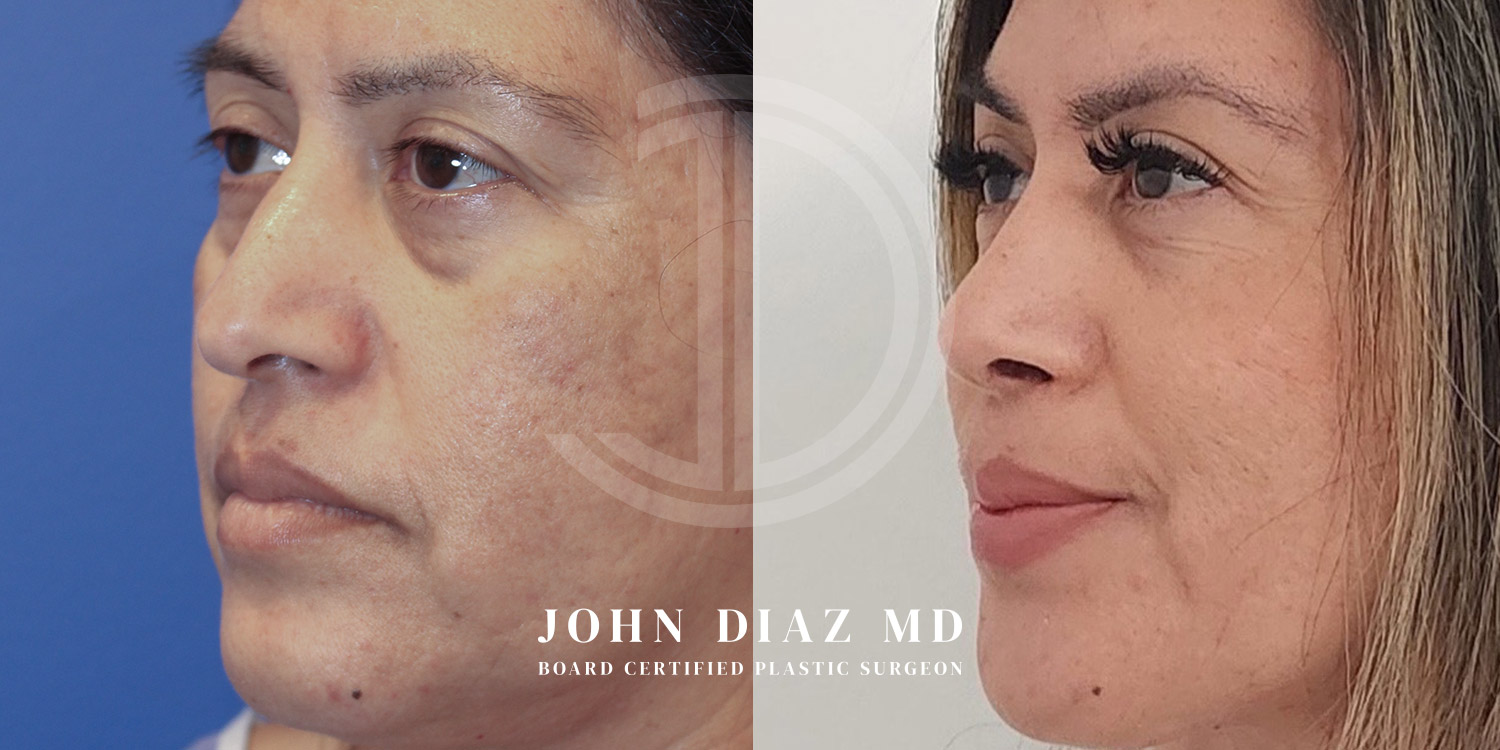 Dr John Diaz Before and After | Rhinoplasty