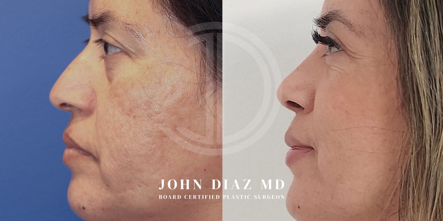 Dr John Diaz Before and After | Rhinoplasty