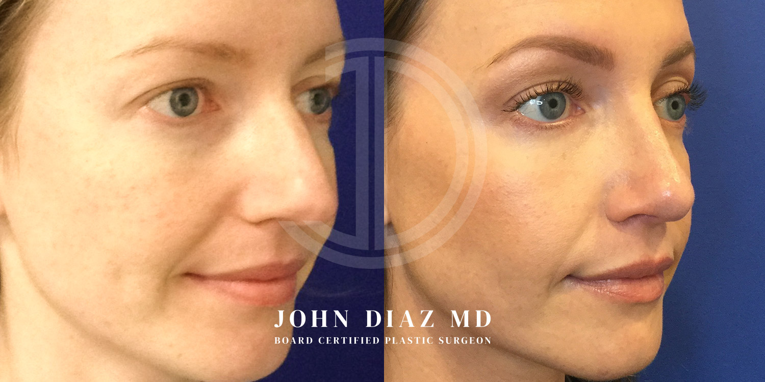Dr John Diaz Before and After | Rhinoplasty