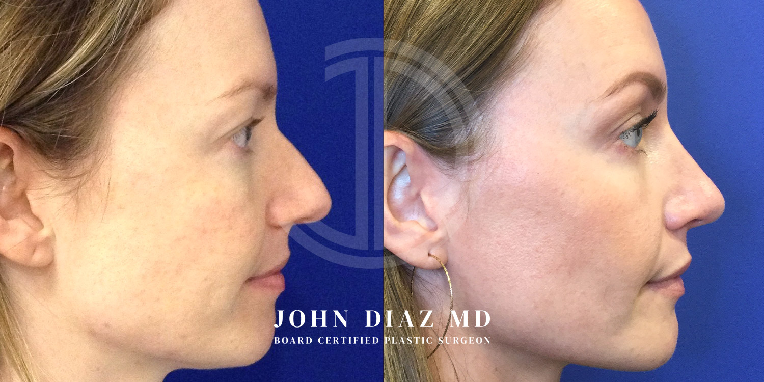 Dr John Diaz Before and After | Rhinoplasty