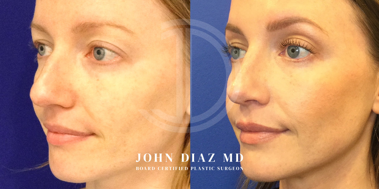 Dr John Diaz Before and After | Rhinoplasty