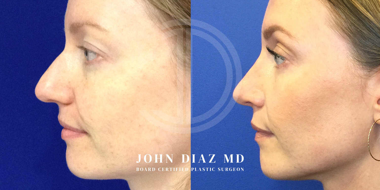Dr John Diaz Before and After | Rhinoplasty