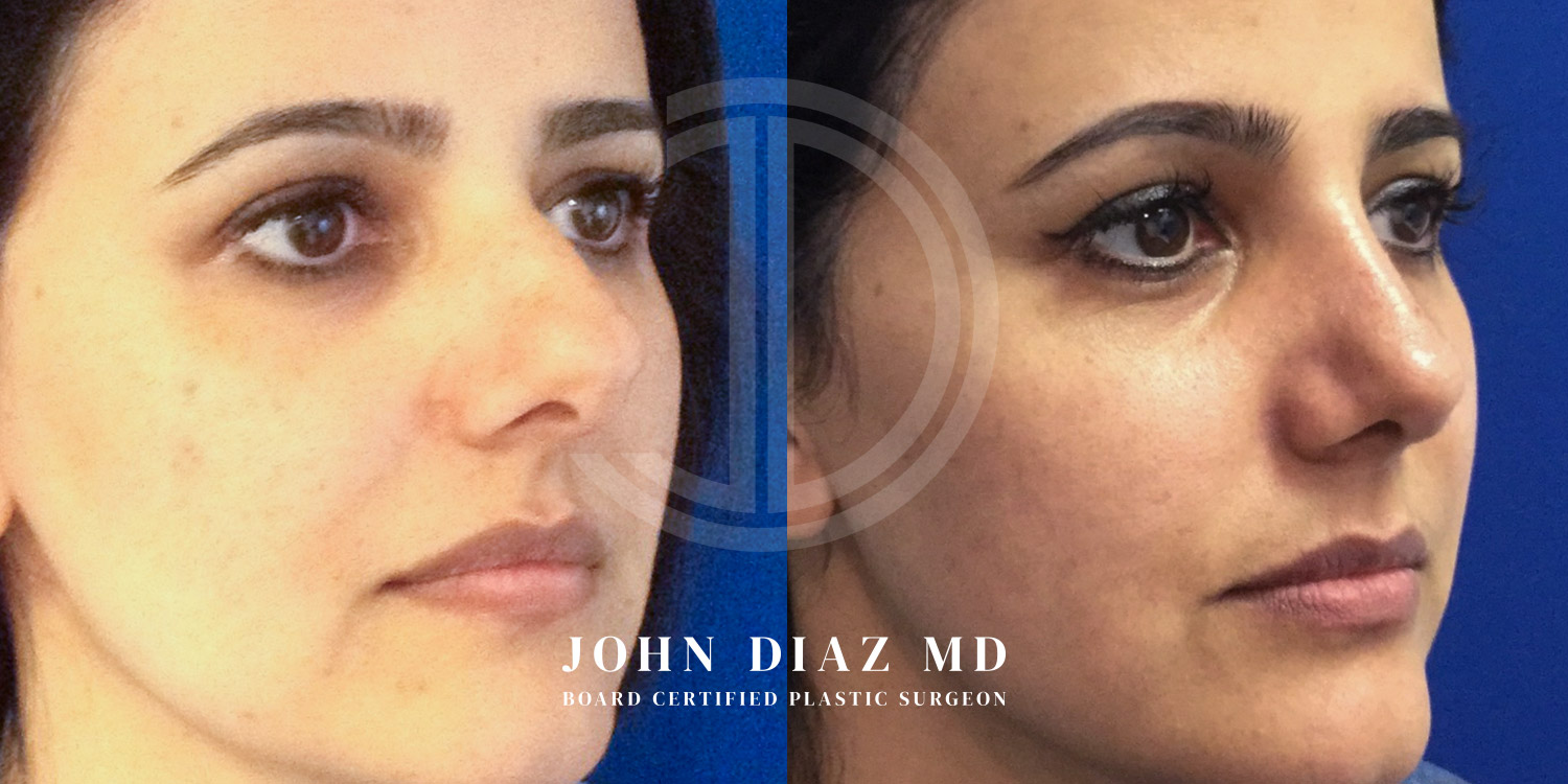 Dr John Diaz Before and After | Rhinoplasty