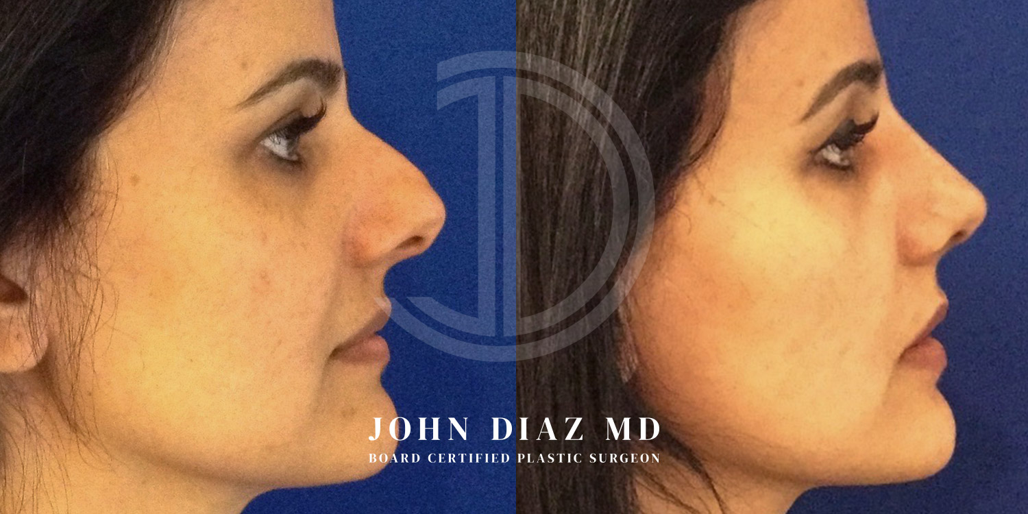 Dr John Diaz Before and After | Rhinoplasty