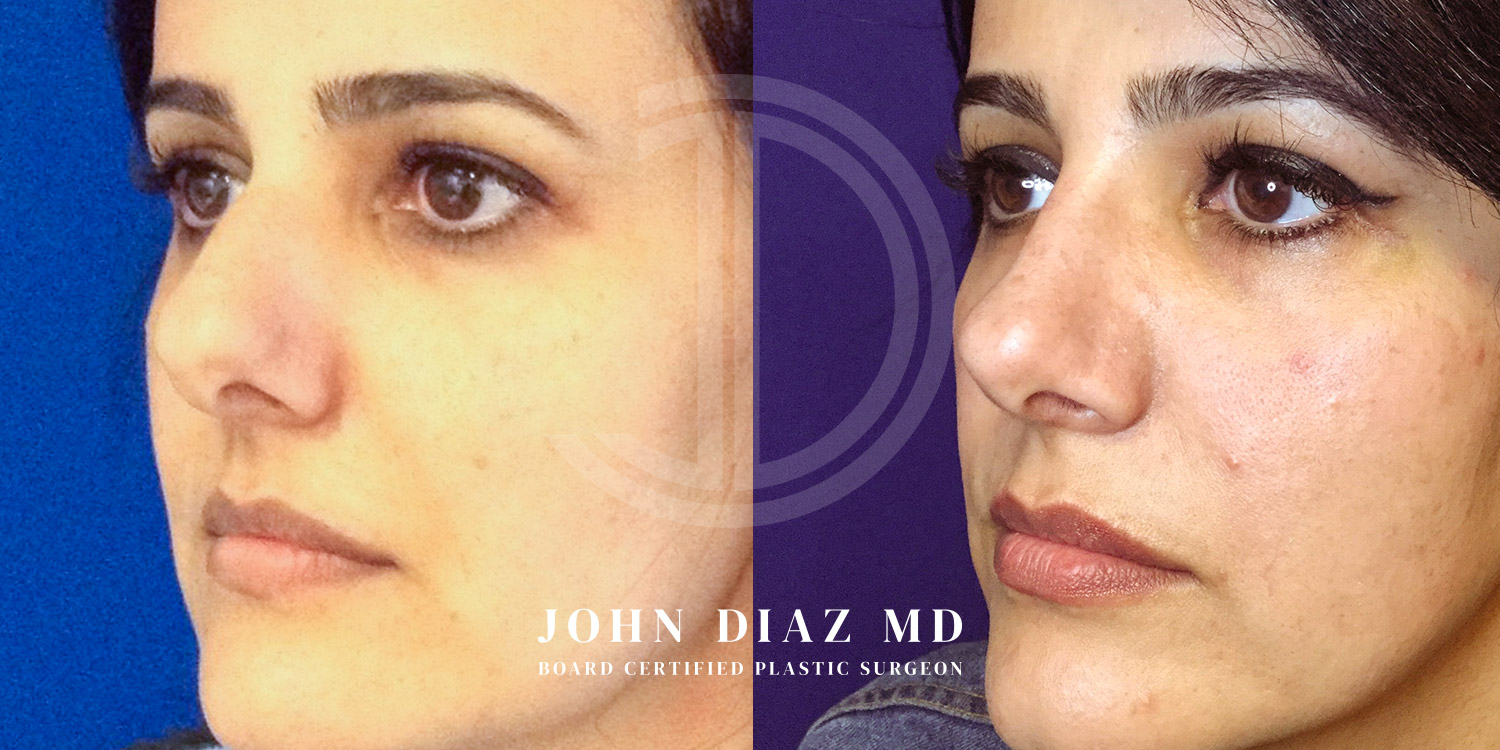Dr John Diaz Before and After | Rhinoplasty