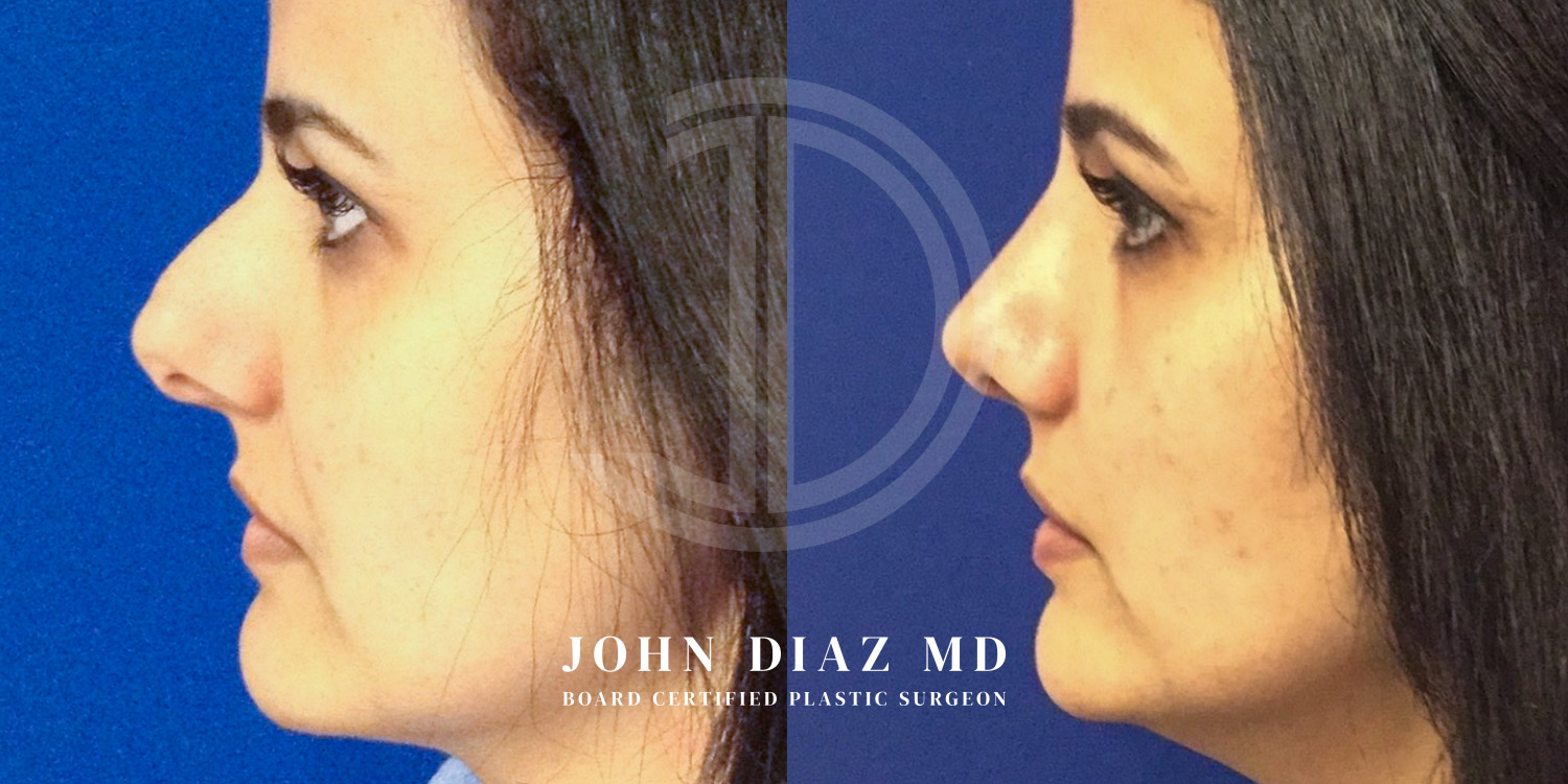 Dr John Diaz Before and After | Rhinoplasty