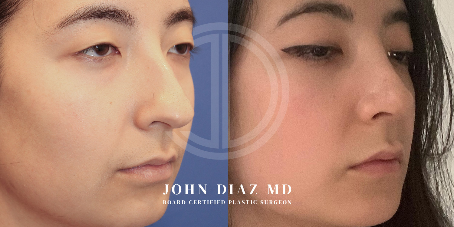 Dr John Diaz Before and After | Rhinoplasty