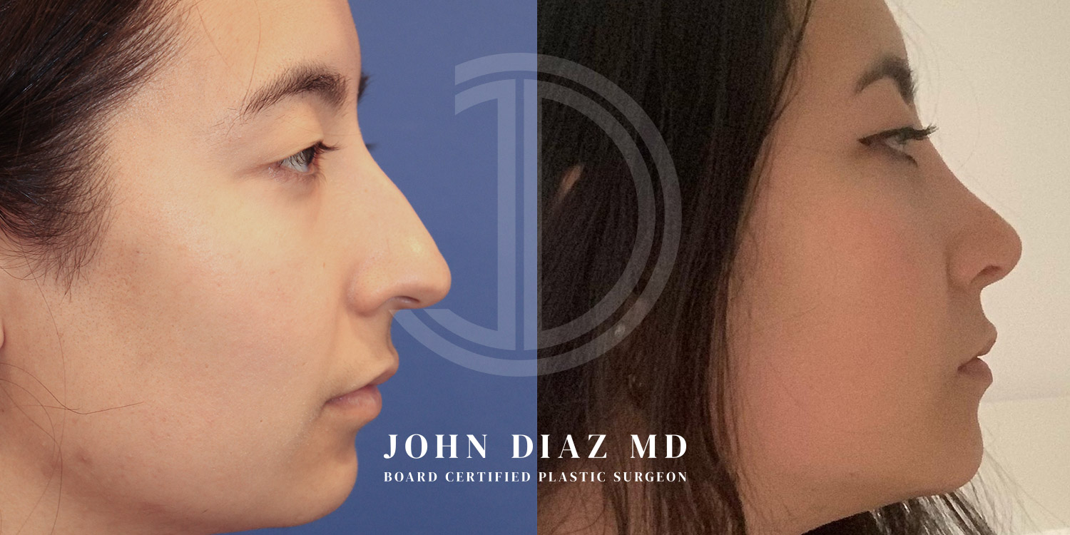 Dr John Diaz Before and After | Rhinoplasty