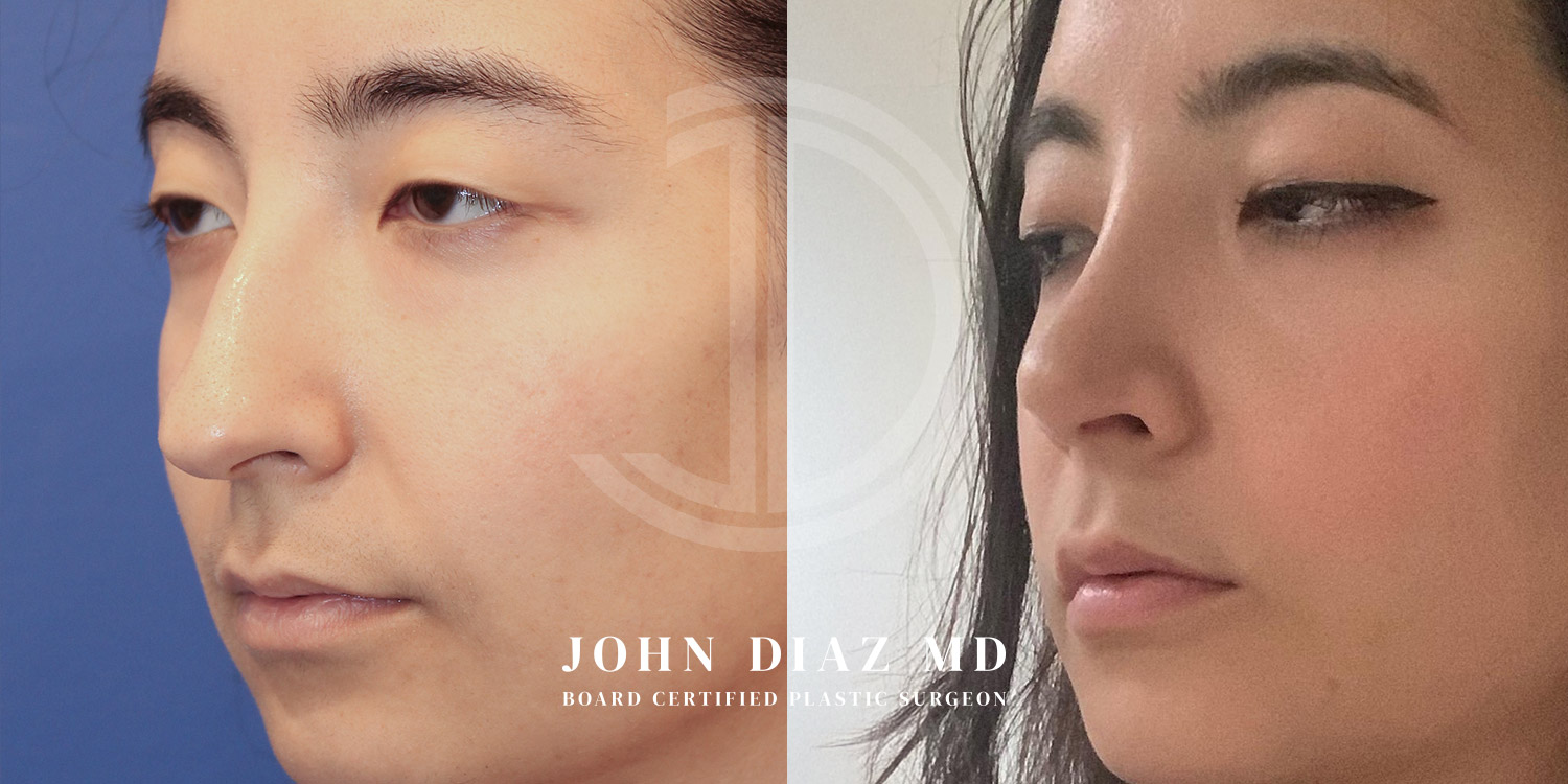 Dr John Diaz Before and After | Rhinoplasty