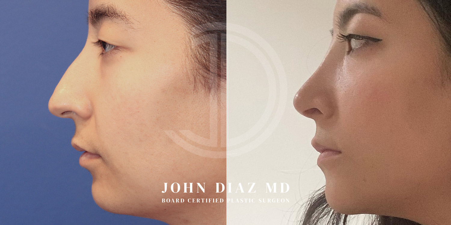 Dr John Diaz Before and After | Rhinoplasty