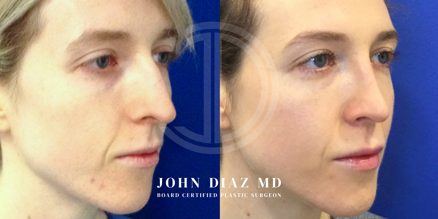 Dr John Diaz Before and After | Rhinoplasty