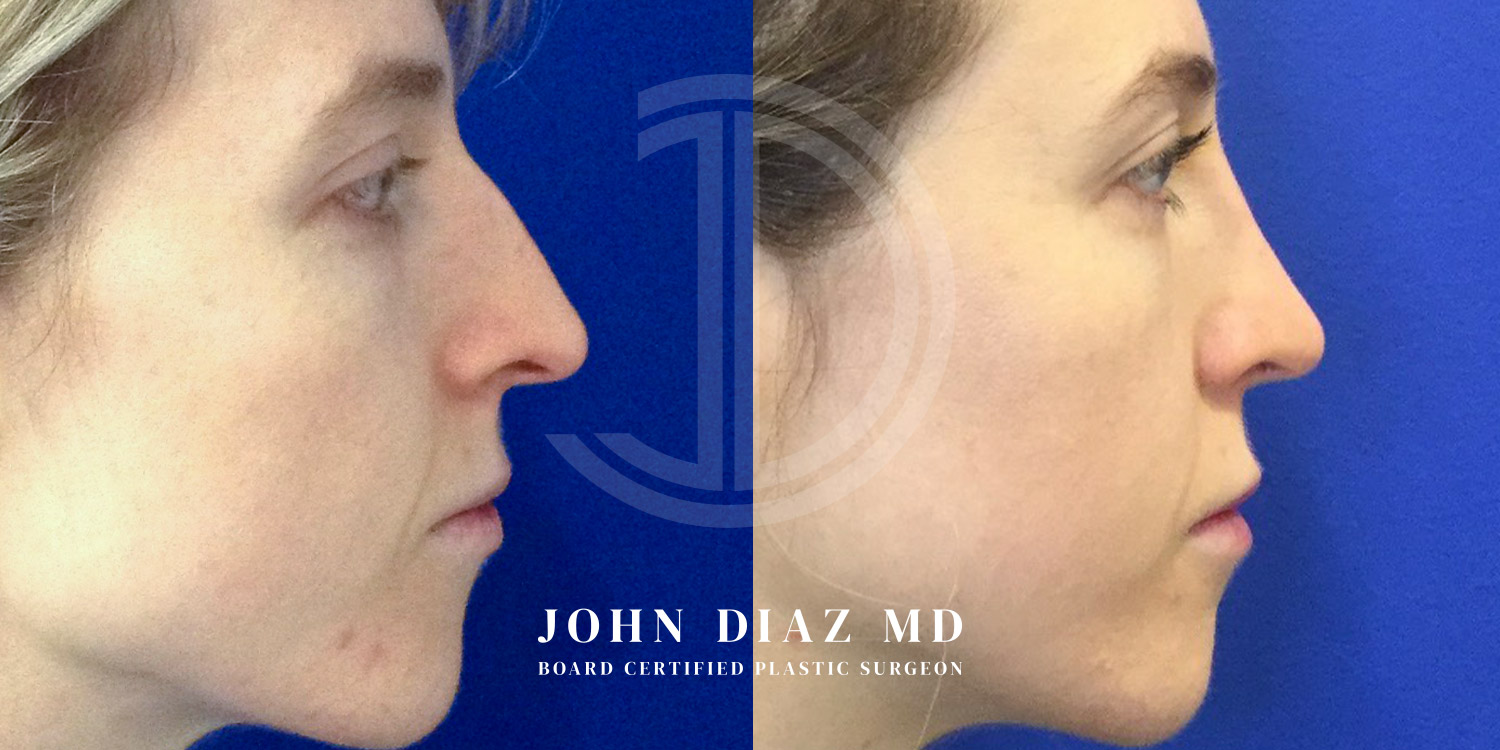 Dr John Diaz Before and After | Rhinoplasty