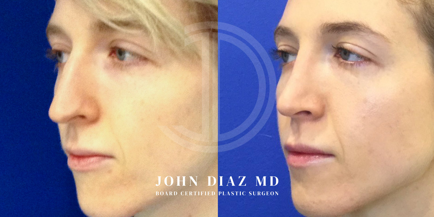 Dr John Diaz Before and After | Rhinoplasty