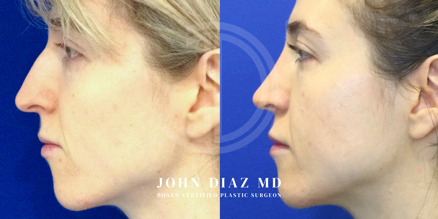 Dr John Diaz Before and After | Rhinoplasty