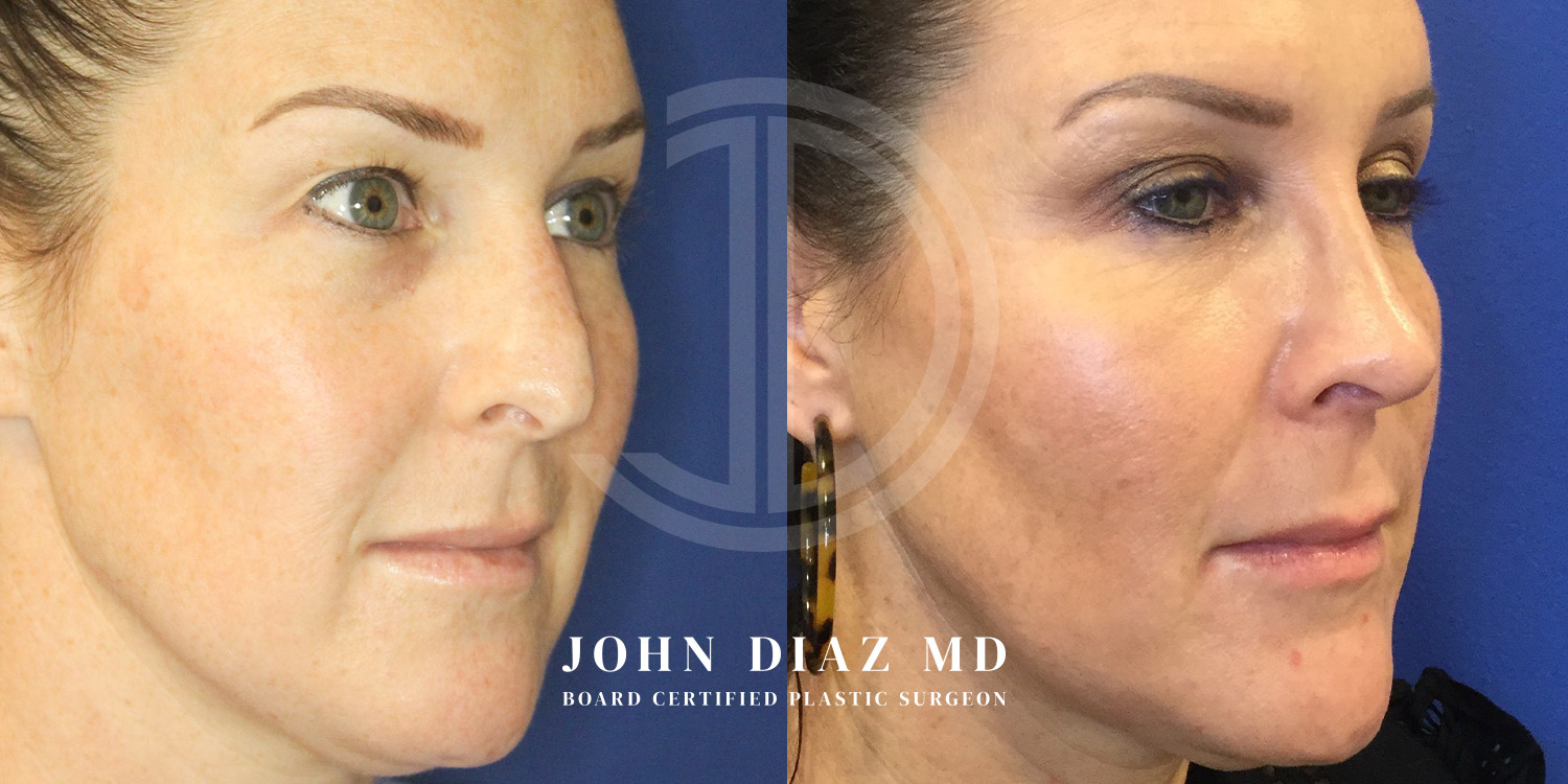 Dr John Diaz Before and After | Rhinoplasty