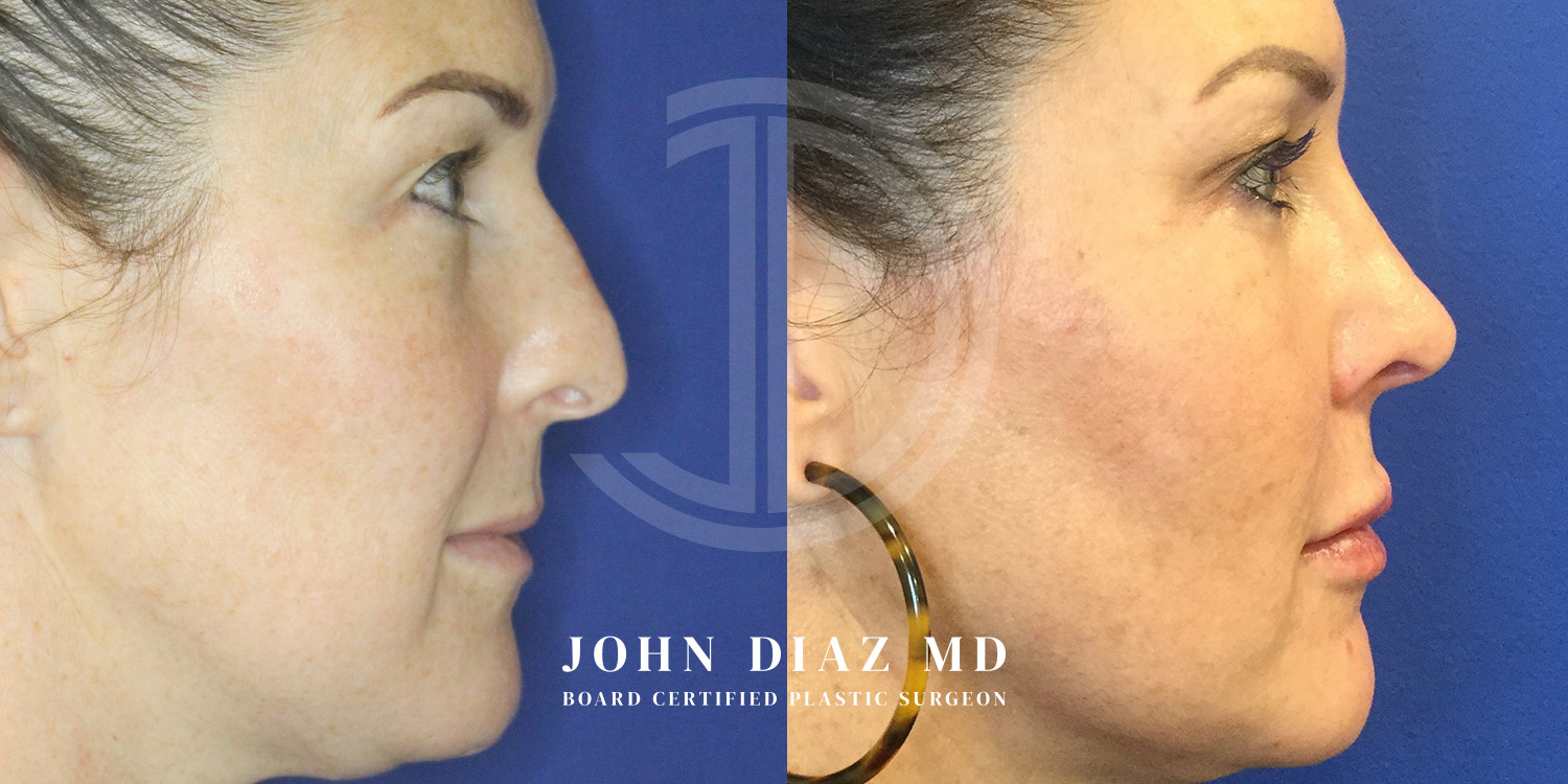 Dr John Diaz Before and After | Rhinoplasty