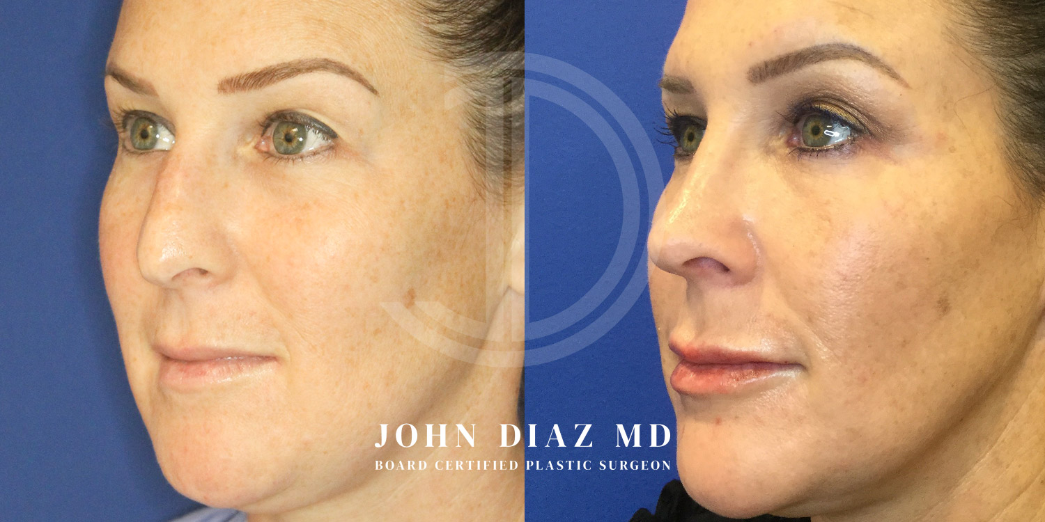 Dr John Diaz Before and After | Rhinoplasty