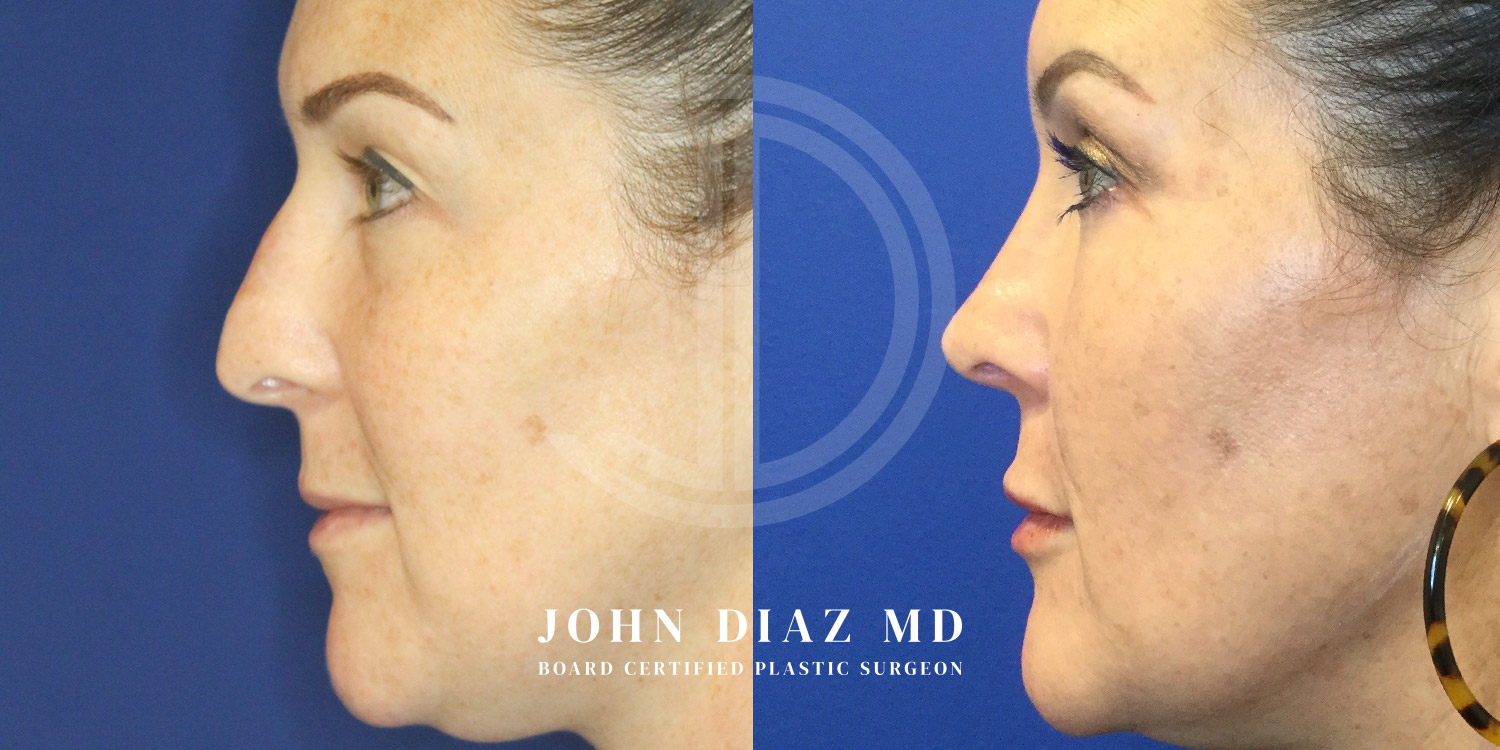 Dr John Diaz Before and After | Rhinoplasty